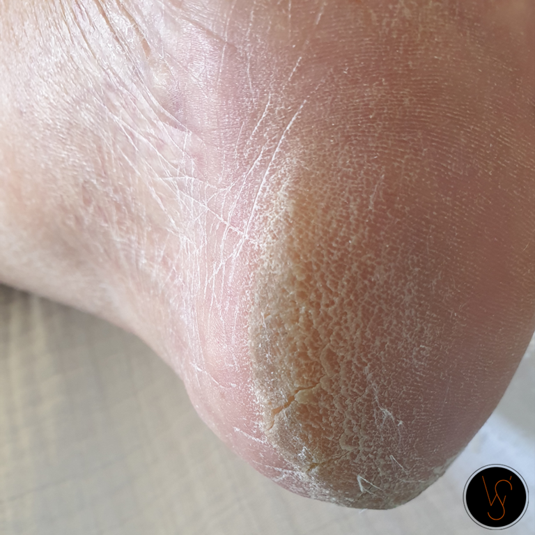 pedicure_wiolettas_hiel_behandeling_kloven_eelt_Arnhem_Doorwerth