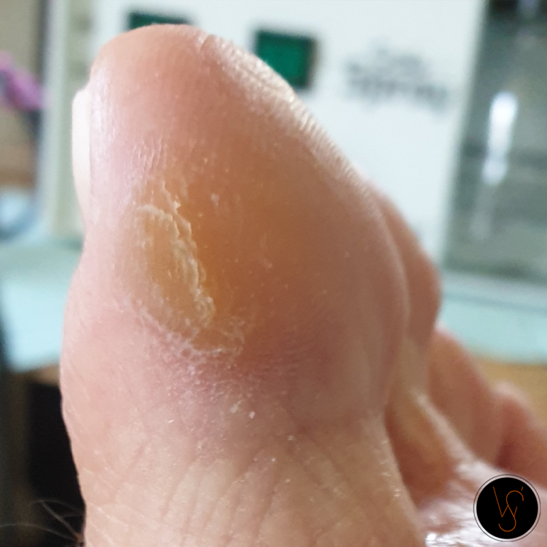 pedicure_wiolettas_teen_behandeling_kloven_eelt_Arnhem_Doorwerth