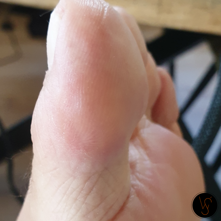 pedicure_wiolettas_teen_behandeling_kloven_eelt_Arnhem_Doorwerth_nijmegen