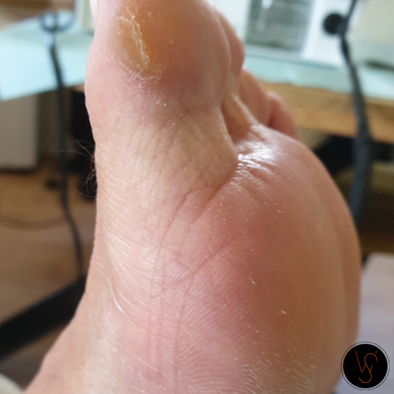 pedicure_wiolettas_teen_behandeling_kloven_eelt_Arnhem_Nijmegen_Doorwerth