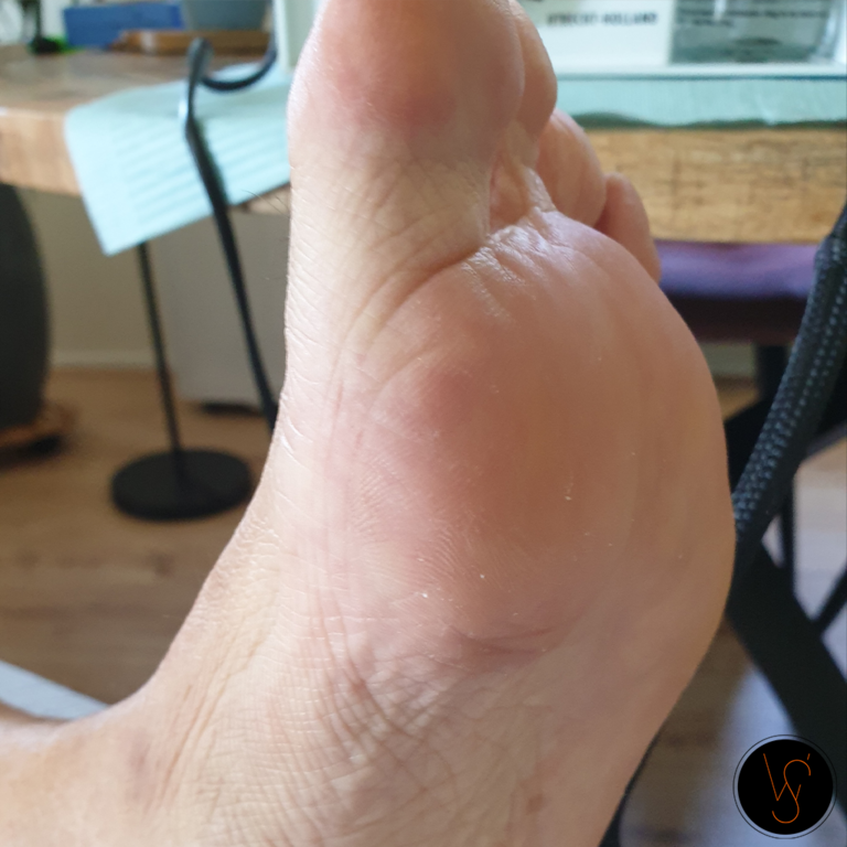 pedicure_wiolettas_teen_behandeling_kloven_eelt_Nijmegen_Arnhem_Doorwerth