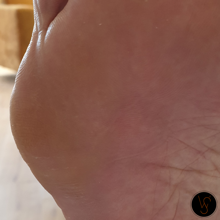 pedicure_wiolettas_voet_behandeling_kloven_eelt_Arnhem_Doorwerth